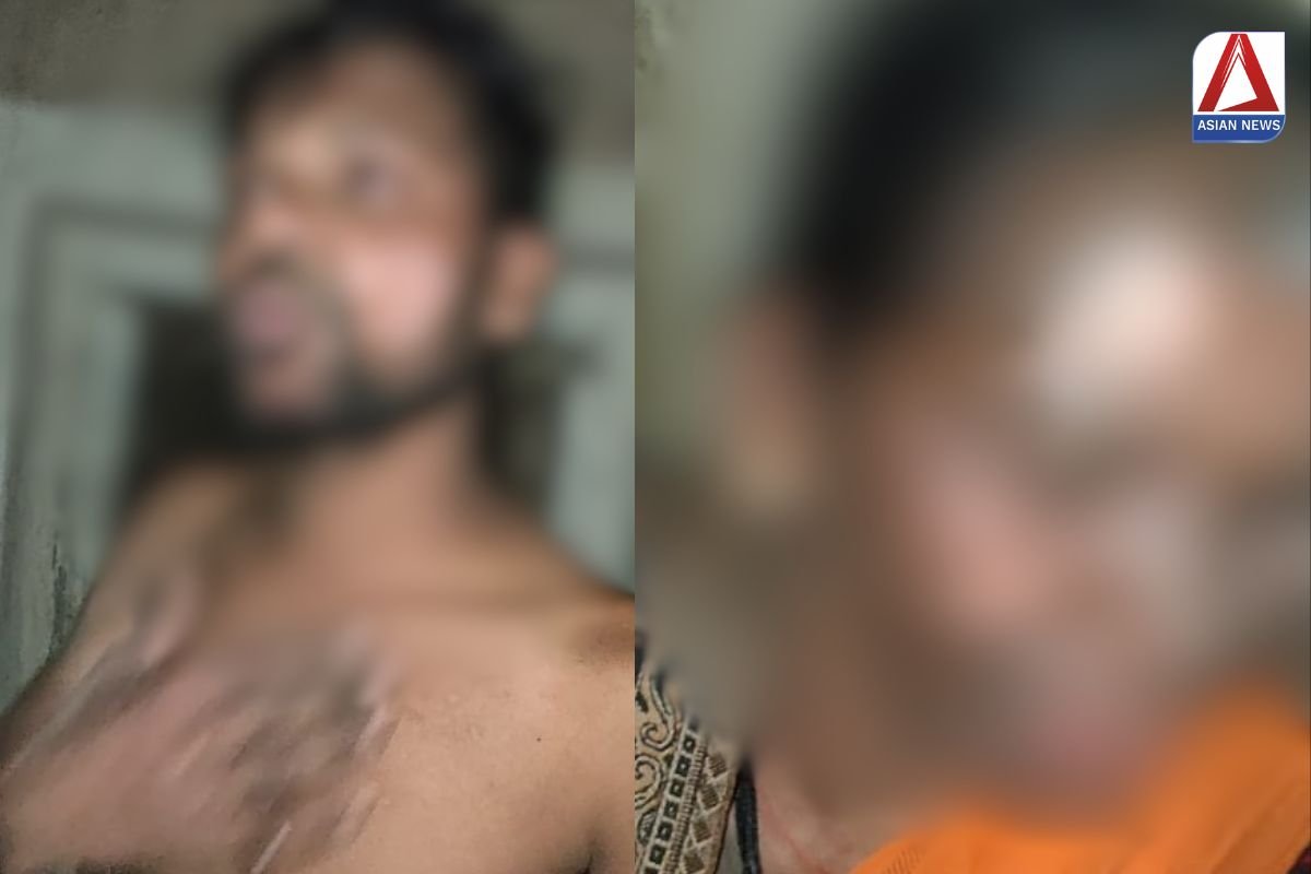 Ambikapur Breaking युवक ने अपने भाई और माँ पर किया एसिड से हमला...