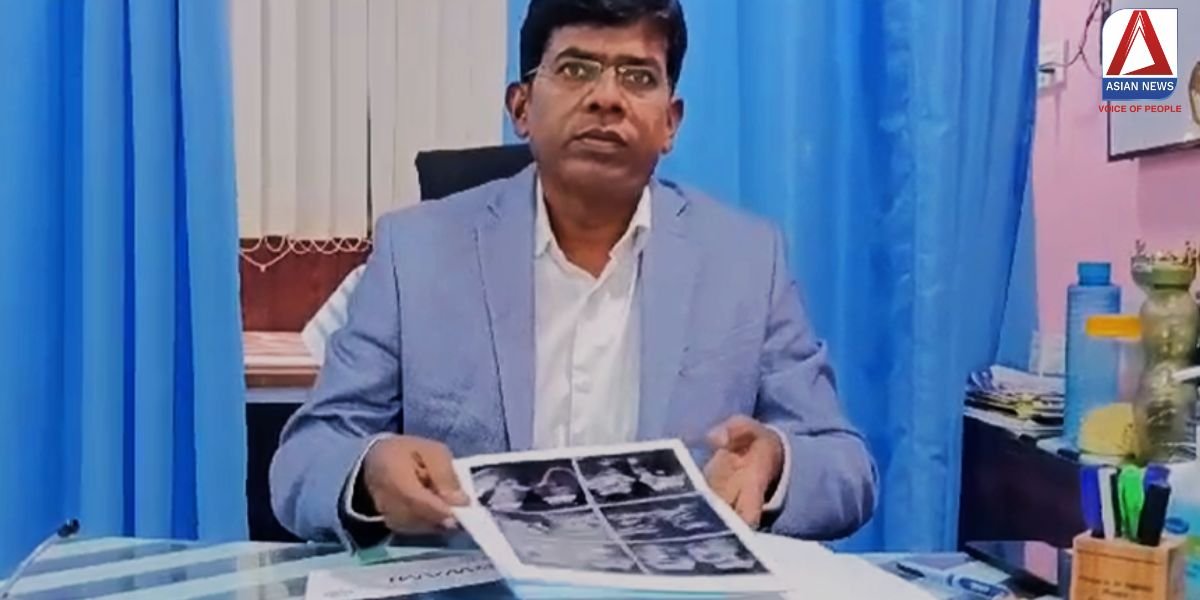 MP Rewa News महिला के गॉलब्लैडर से निकले 1235 स्टोन, डॉक्टर रह गए हैरान