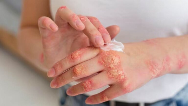 Herpes Virus से अल्जाइमर का खतरा बढ़ने का दावा, स्टडी में हुआ चौंकाने वाला खुलासा...