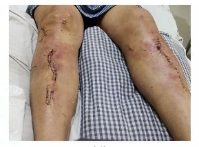 शर्मनाक: आउटडोर एडवर्टाइजमेंट ग्रेसफुल कंपनी के मालिक विश्वरंजन पुरोहित पर जानलेवा हमला, पुलिस की गिरफ्त से बाहर हैं आरोपी...