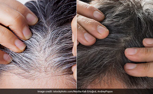 Hair Care : कम उम्र में सफेद बाल? जानें कारण, फॉलो करें ये नेचुरल टिप्स...