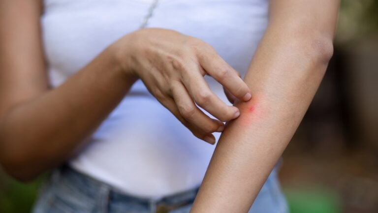 Home Remedies for Mosquito Bites: मच्छर के काटने से खुजली और जलन से पाएं तुरंत राहत...