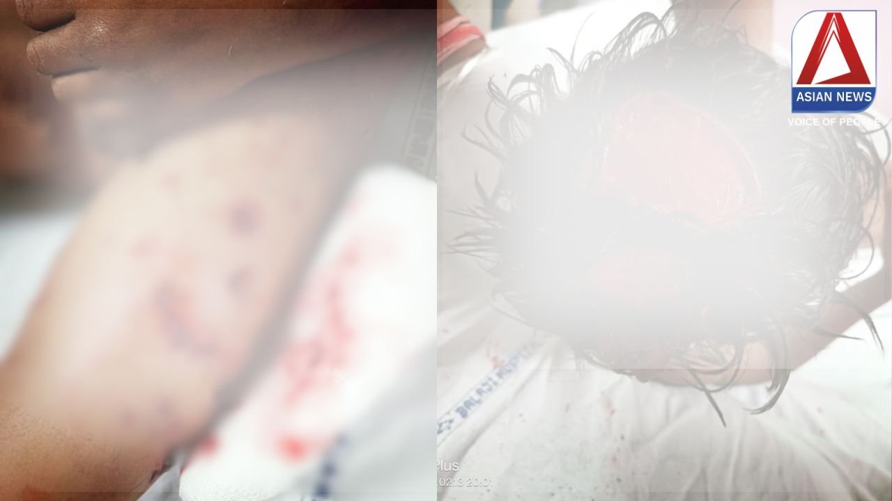 Raipur News : आवारा कुत्तों ने किया 6 साल के बच्चे पर जानलेवा हमला.....