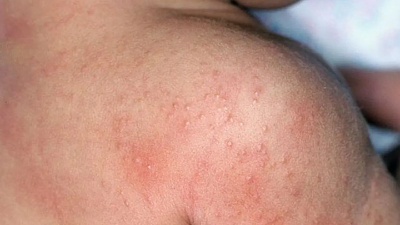 Prickly Heat Home Remedy: गर्मियों में घमौरियों और खुजली से राहत के लिए आजमाएं ये देसी नुस्खे...