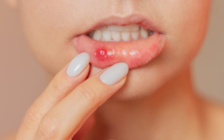 Mouth Ulcers : बार-बार मुंह में छाले होना हो सकता है गंभीर बीमारी का संकेत, जानें कारण और बचाव के उपाय