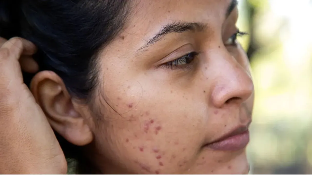 Pimples Home Remedies: गर्मियों में पिंपल्स से परेशान हैं? अपनाएं ये आसान घरेलू उपाय और पाएं साफ-सुथरी त्वचा