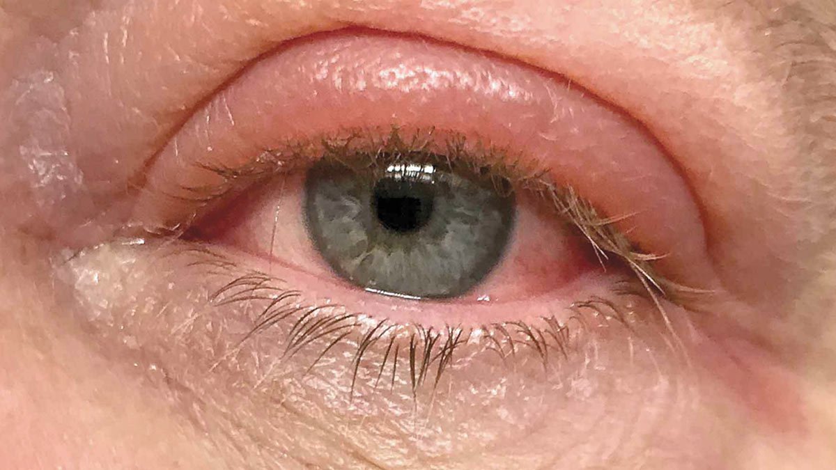 Conjunctivitis : गर्मी और बारिश में तेजी से फैल रही है 'पिंक आई', जानें लक्षण और बचाव के तरीके