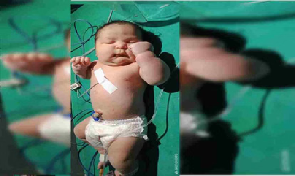 CG News: A 'little giant' born at Mekaj; newborn weighing over 5 kg surprises even the doctors.